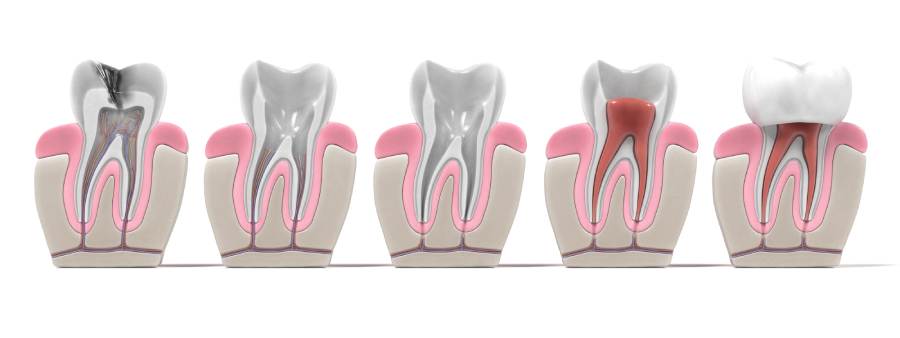 endodoncia profesional