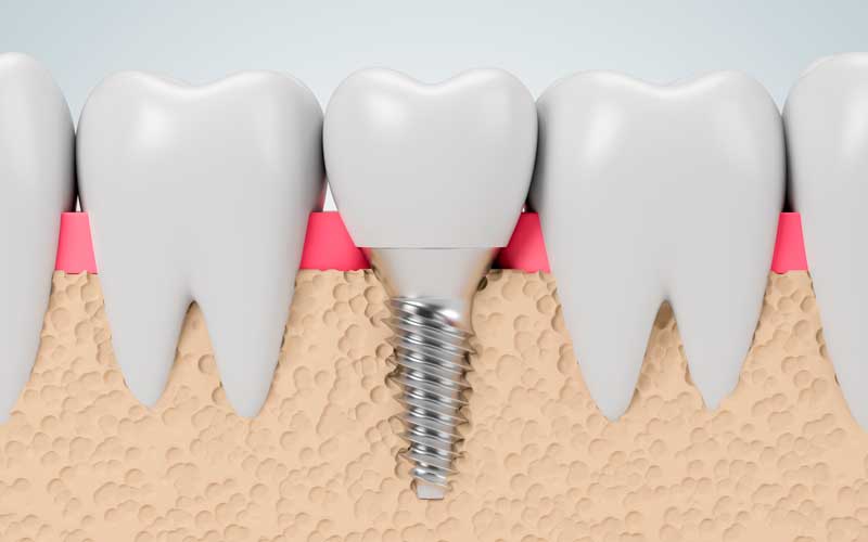 implantes personas mayores